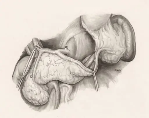 Operation on human tissue