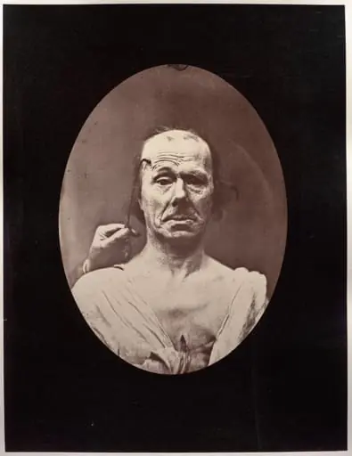 Figure 7: Étude du méchanisme et de l'expression du muscle frontal chez un vieillard: à droit, attention; à gauche, repos