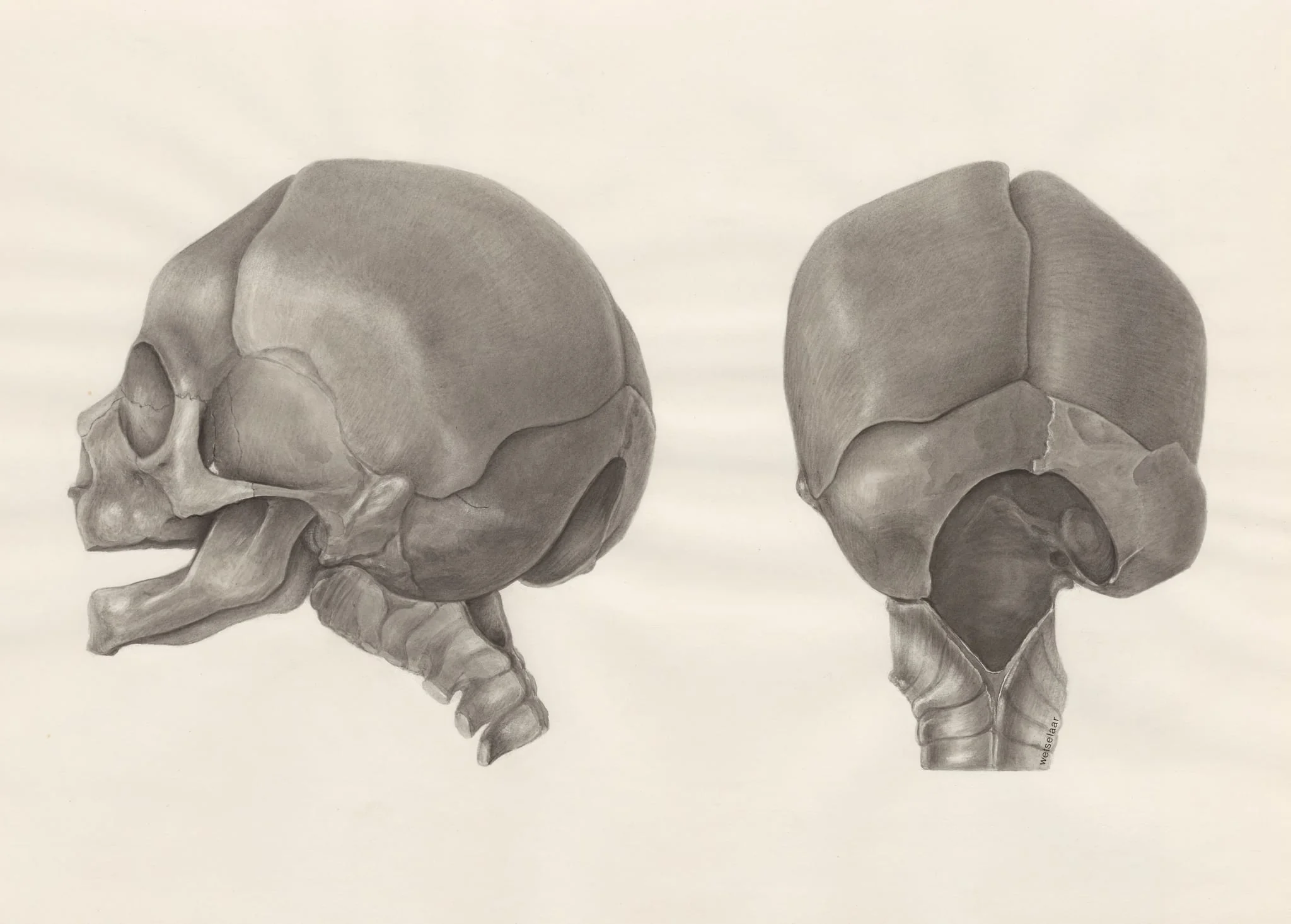 Deformed fetal skull, with part of the spinal cord