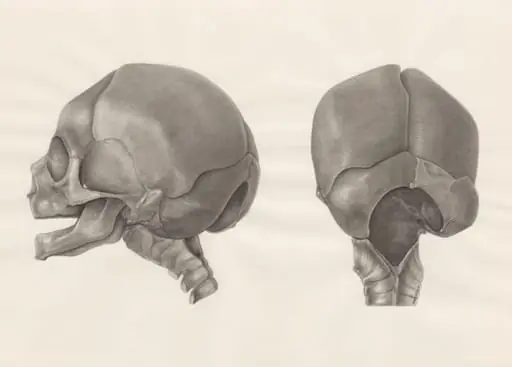 Deformed fetal skull, with part of the spinal cord