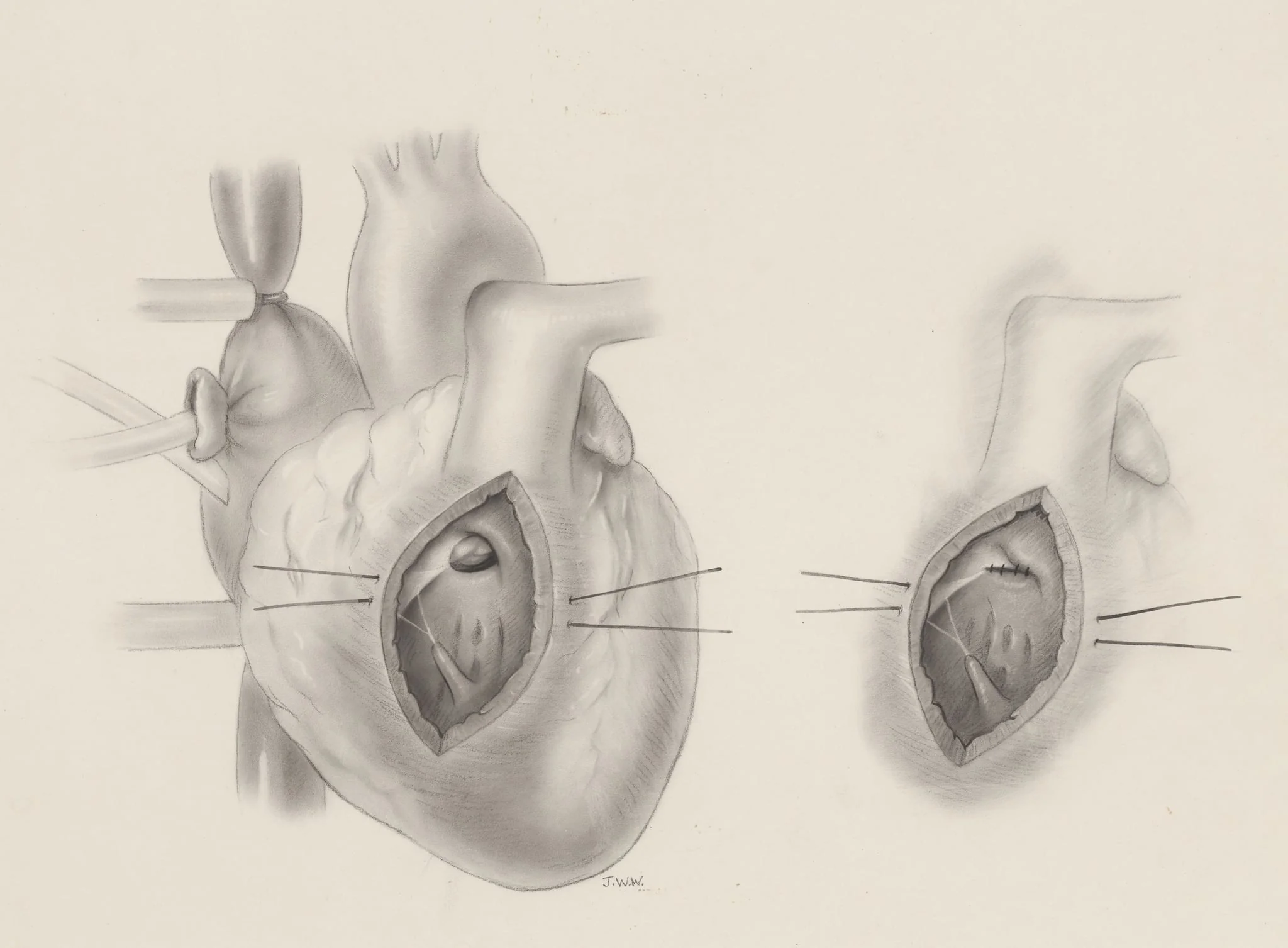 Ventricular septal