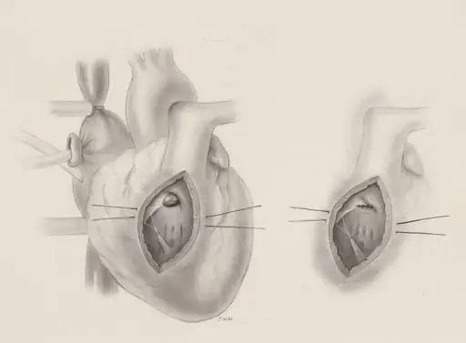 Ventricular septal