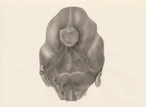 Deformed fetal head, seen from the back