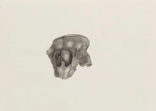 Part of a deformed fetal head