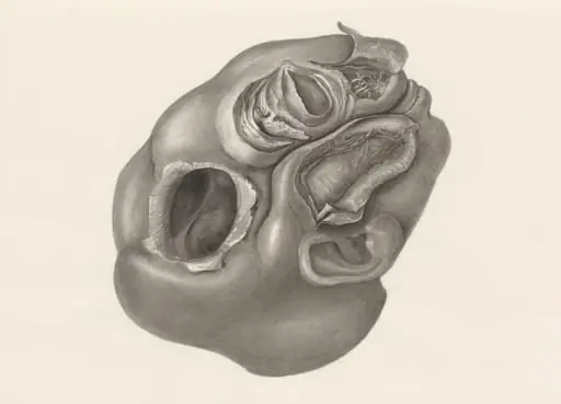 Deformed fetal head, lateral view