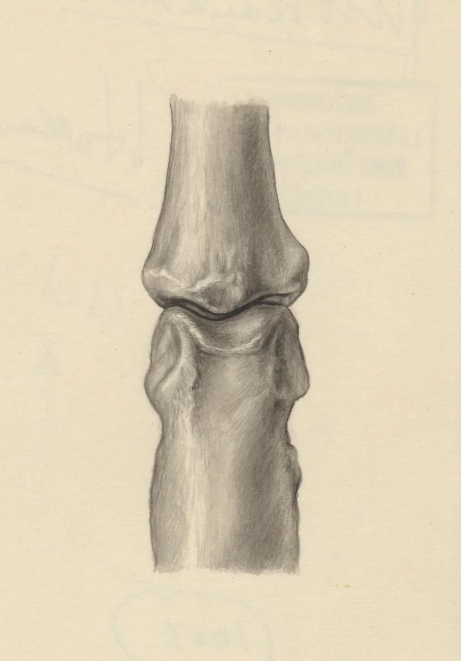 Joints of the hand or fingers, by J Tinkelenberg, 1953