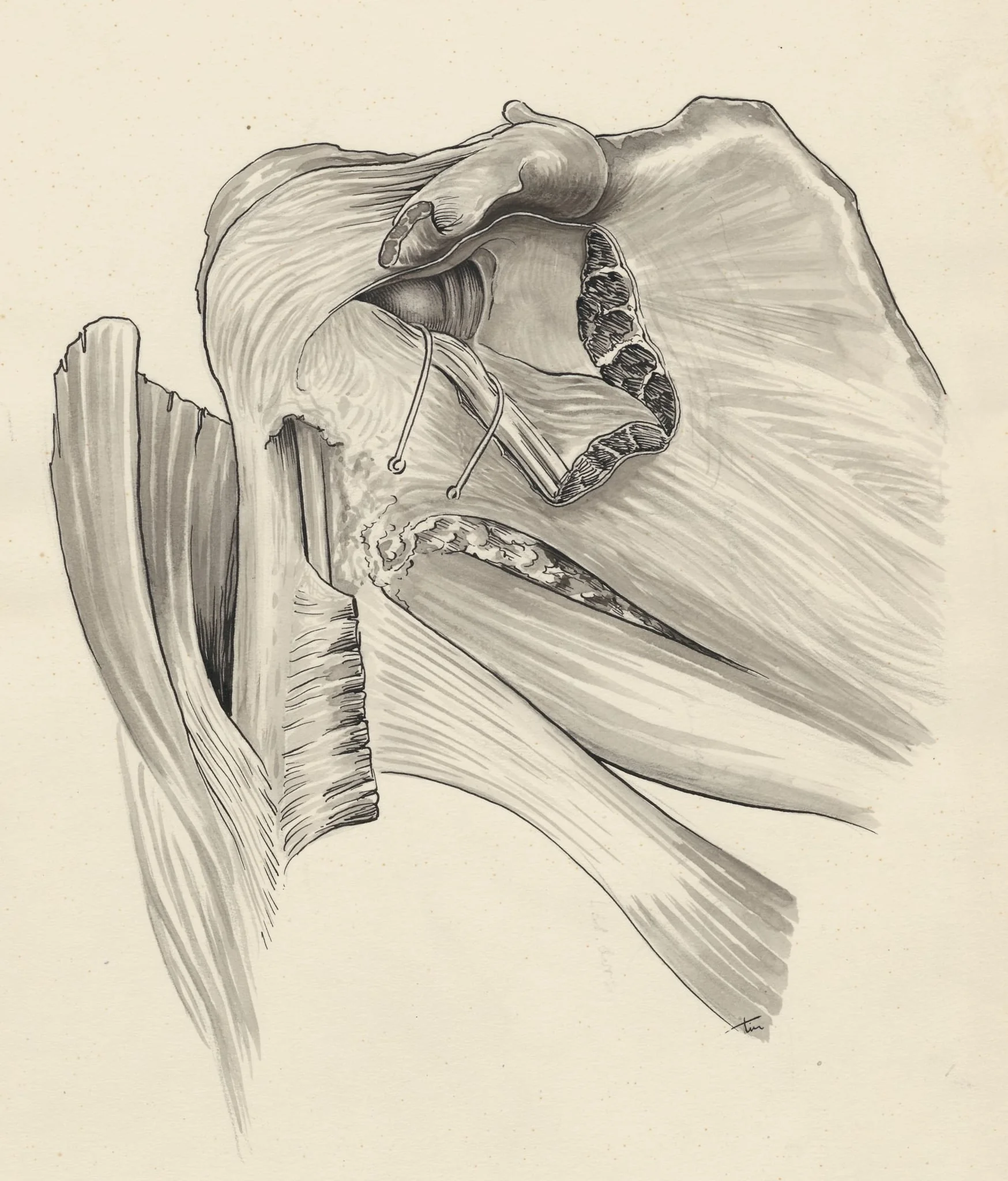 Damage of the pelvic bones, by J Tinkelenberg, 1959
