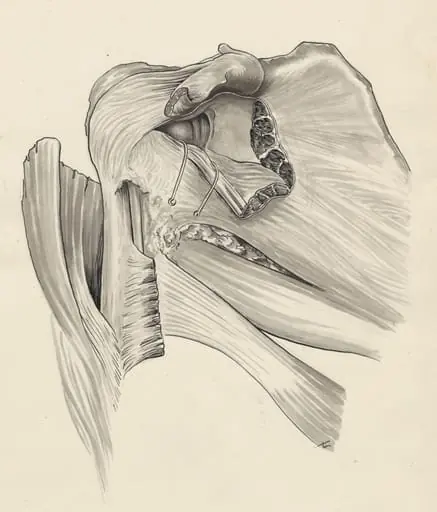 Damage of the pelvic bones