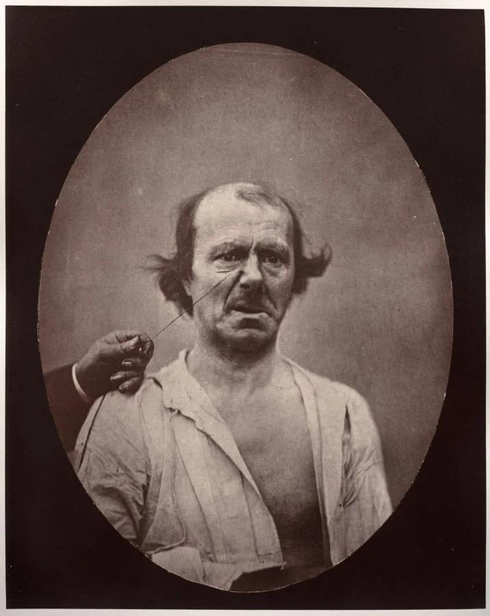 Figure 51: À droite, contraction partielle de l'élévateur commun de l'aile du nez et de la lèvre supérieure: mécontentement, mauvaise humeur; à gauche, repos, by Guillaume-Benjamin-Amand Duchenne (de Boulogne), 1856
