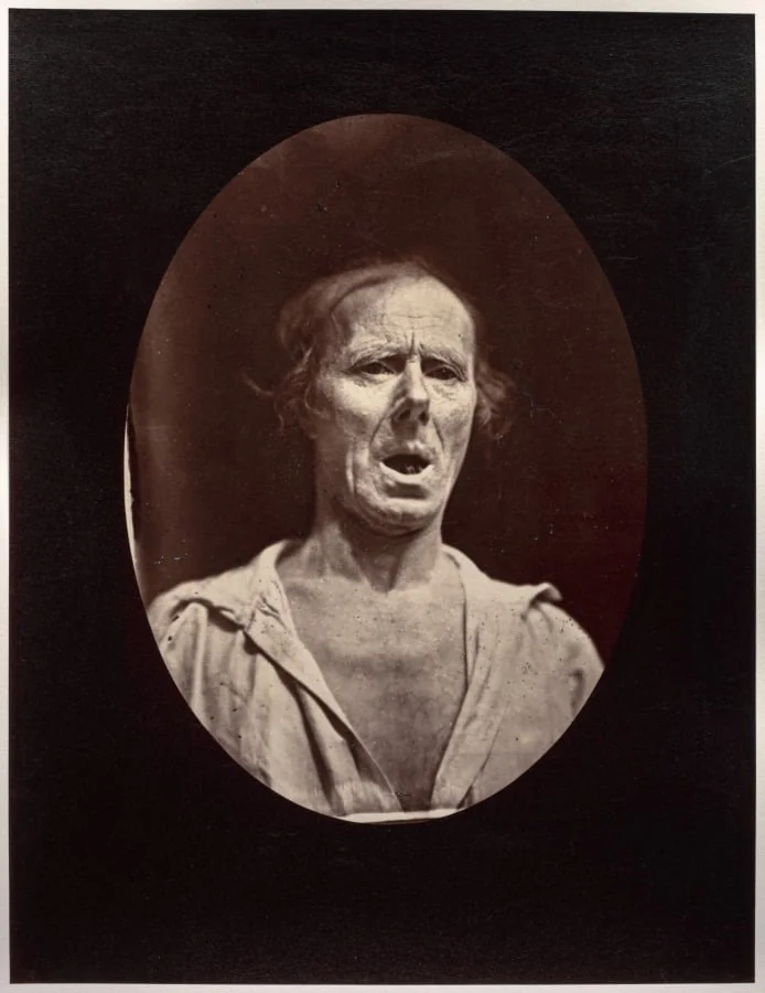 Figure 54: Abaissement volontaire de la mâchoire inférieure: mouvement inexpressif, by Guillaume-Benjamin-Amand Duchenne (de Boulogne), 1856