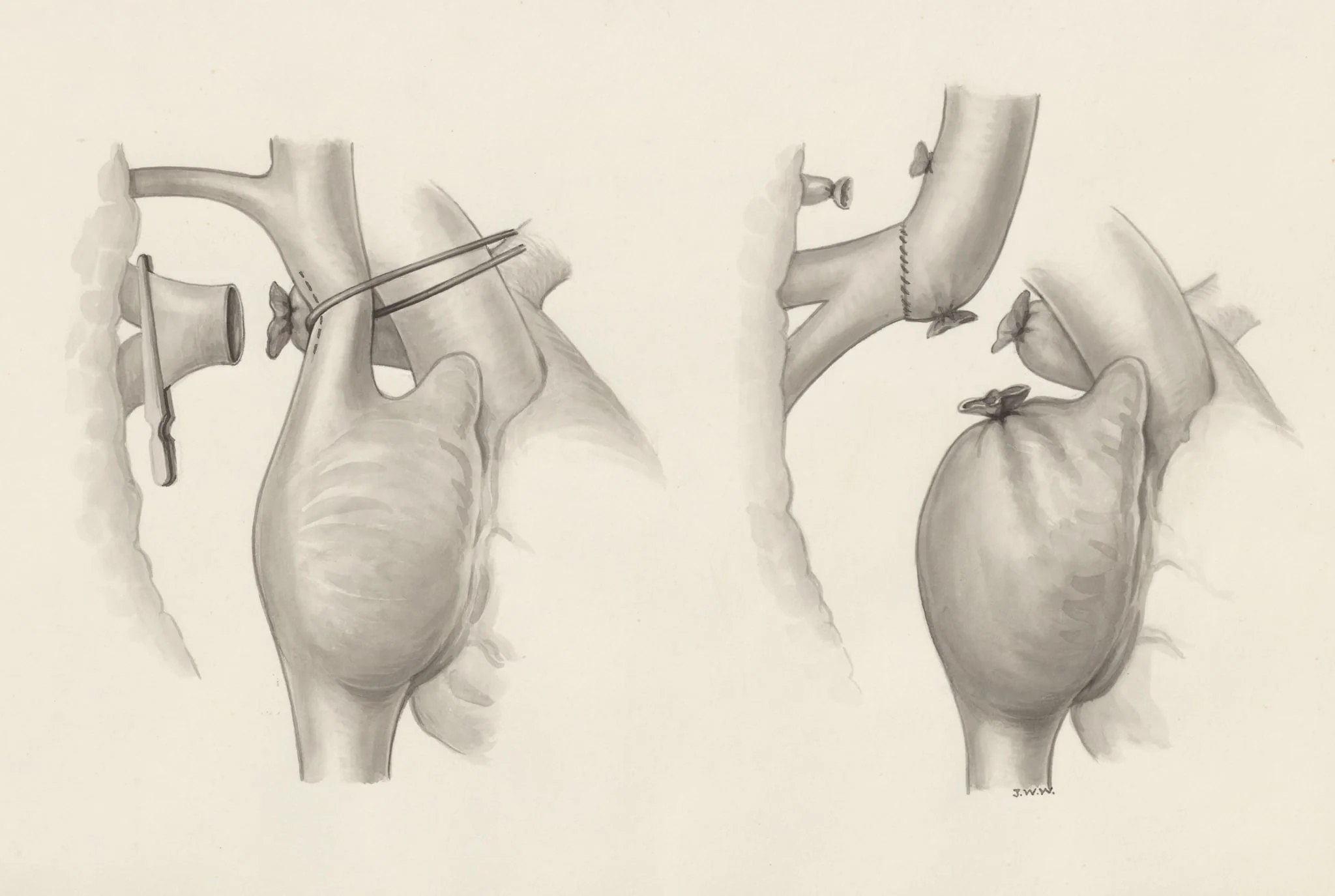 Heart surgery
