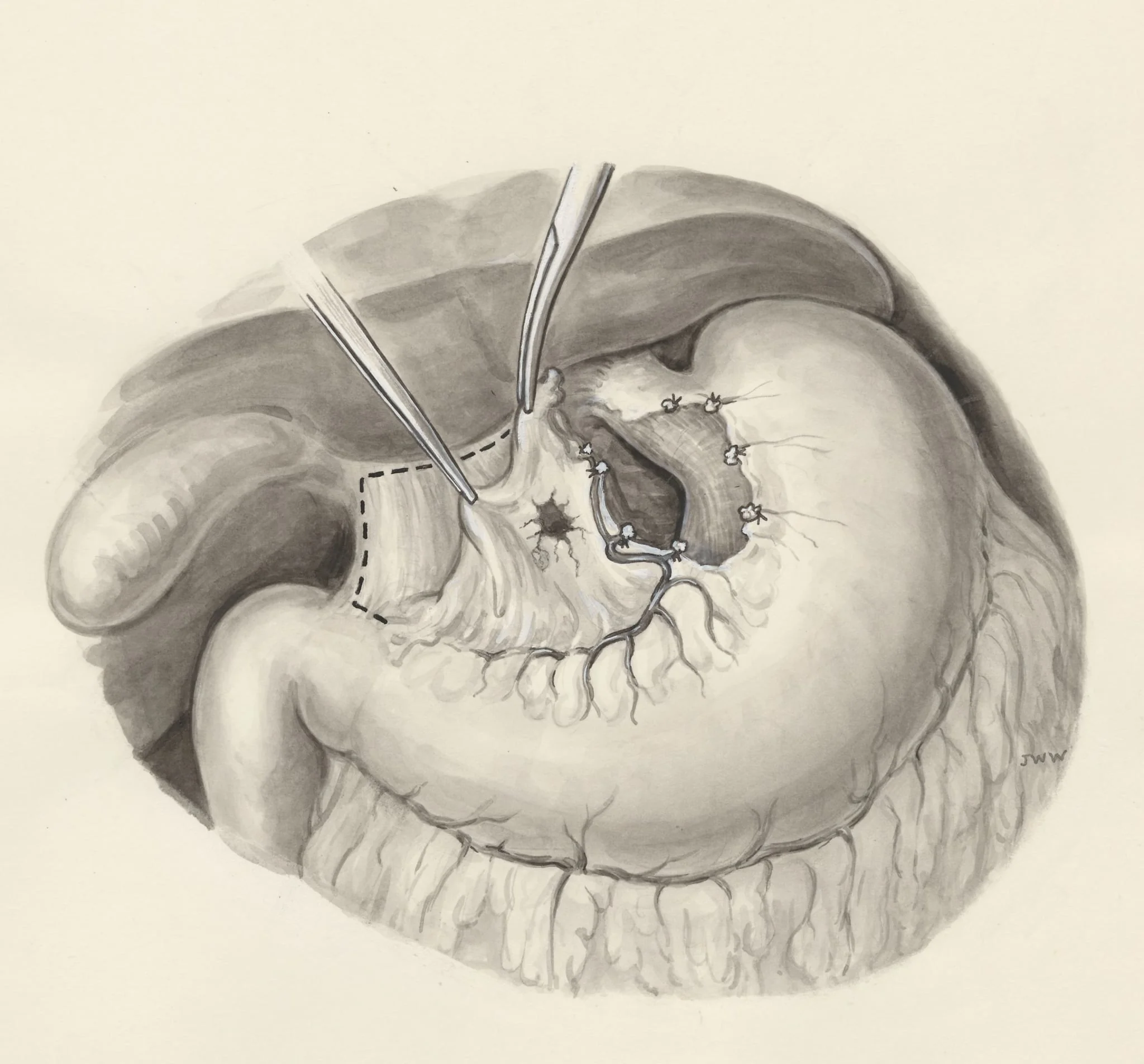 Surgery on a part of the human body, by J Wetselaar-Whittaker, 1970