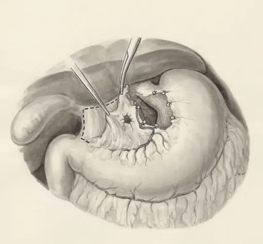 Surgery on a part of the human body