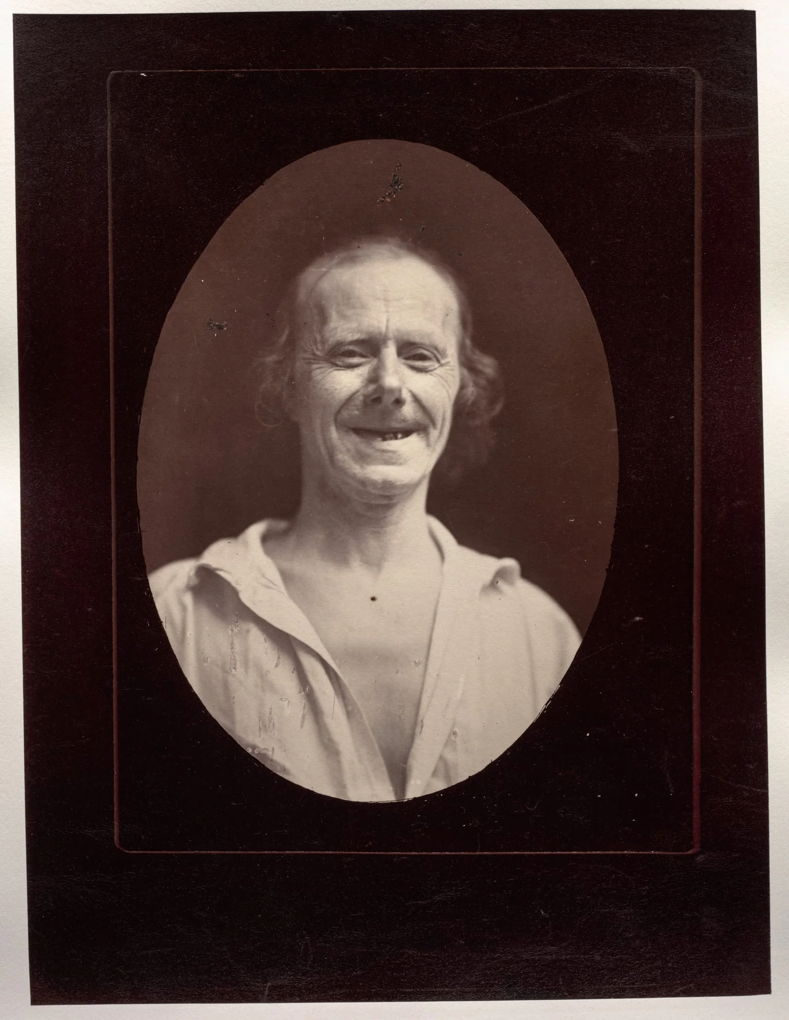 Figure 32: Natural laughter by the voluntary contraction of the two large zygomatics and the lower palpebral orbicularis, by Guillaume-Benjamin-Amand Duchenne (de Boulogne), 1856