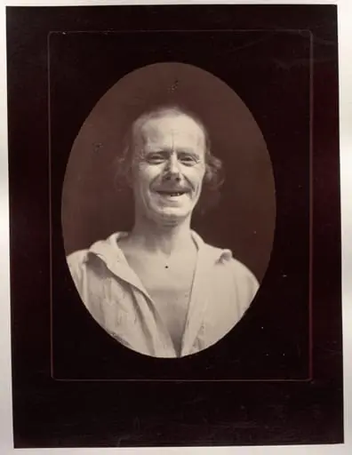 Figure 32: Natural laughter by the voluntary contraction of the two large zygomatics and the lower palpebral orbicularis