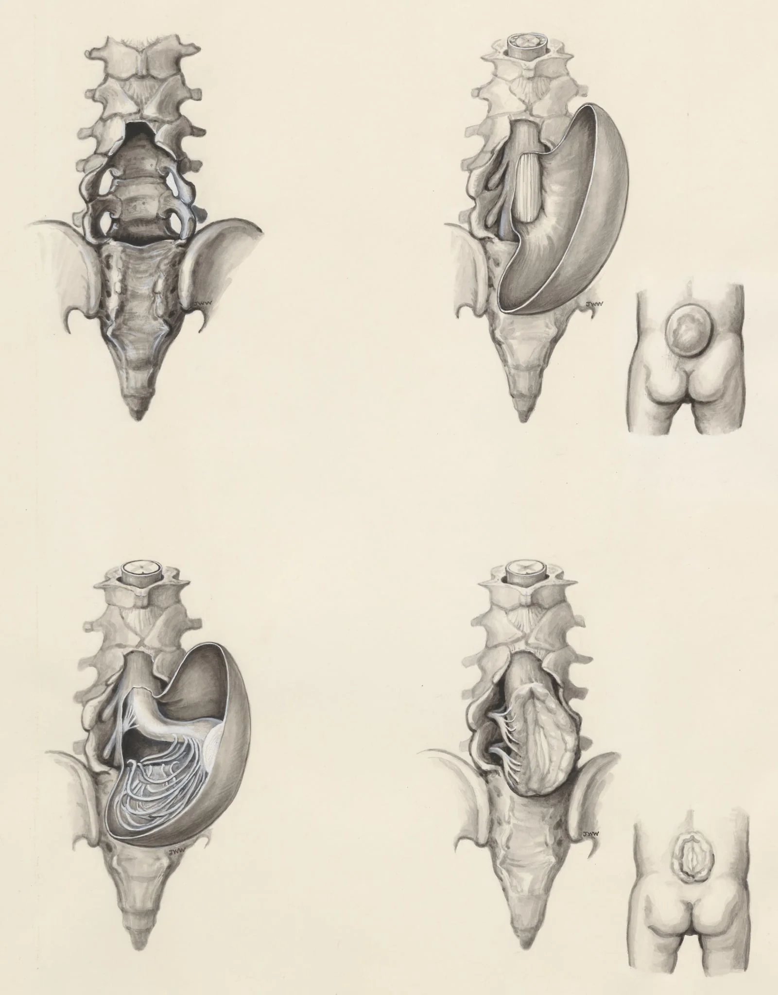 Protrusion of the lower back