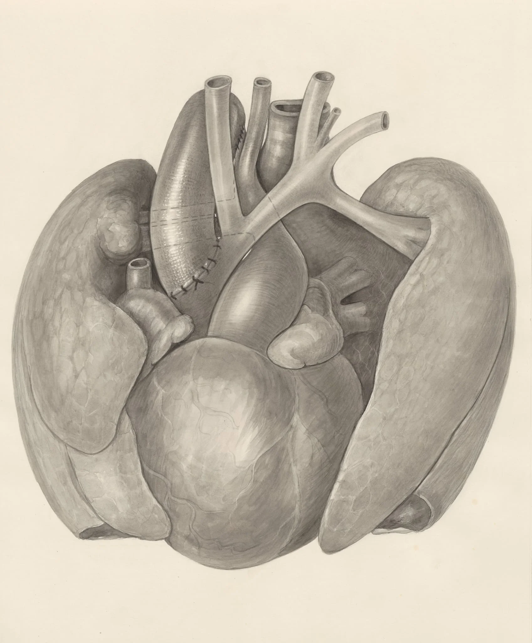 Surgical procedure on a heart and adjacent organs, by H.G, Wetselaar, 1970